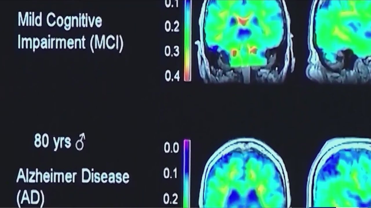 New Alzheimer's drug, donanemab, to be approved by FDA end of this year