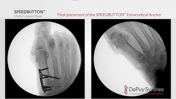 SPEEDBUTTON™ Extracortical Soft-Tissue Anchor - Cadaveric Surgical Demo