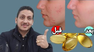 استخدموا هذا الزيت للتخلص من حفر الوجه واثار حب الشباب