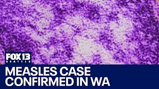 Famous First WA measles case of 2025 Profile
