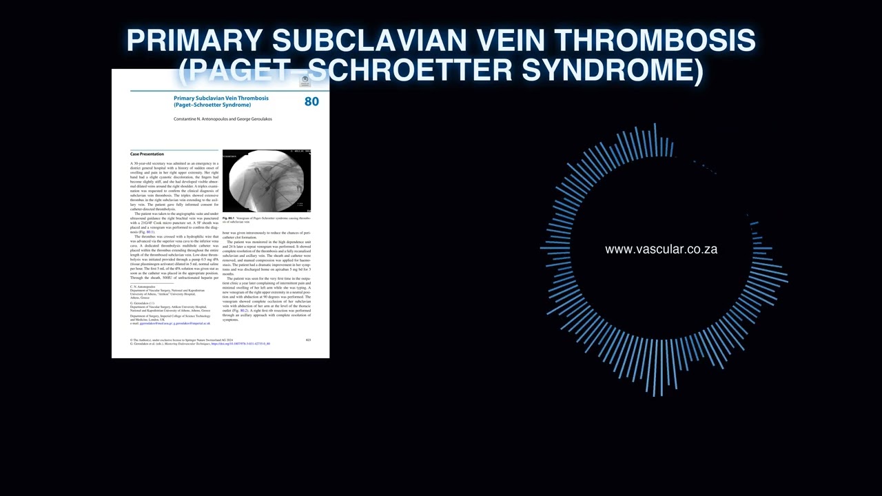 MET - 80 - Primary Subclavian Vein Thrombosis Paget–Schroetter Syndrome - Deep Dive Podcast