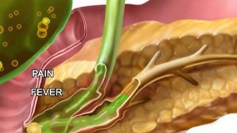 Gallstone Pancreatitis (Gallstone) - Meditoons™