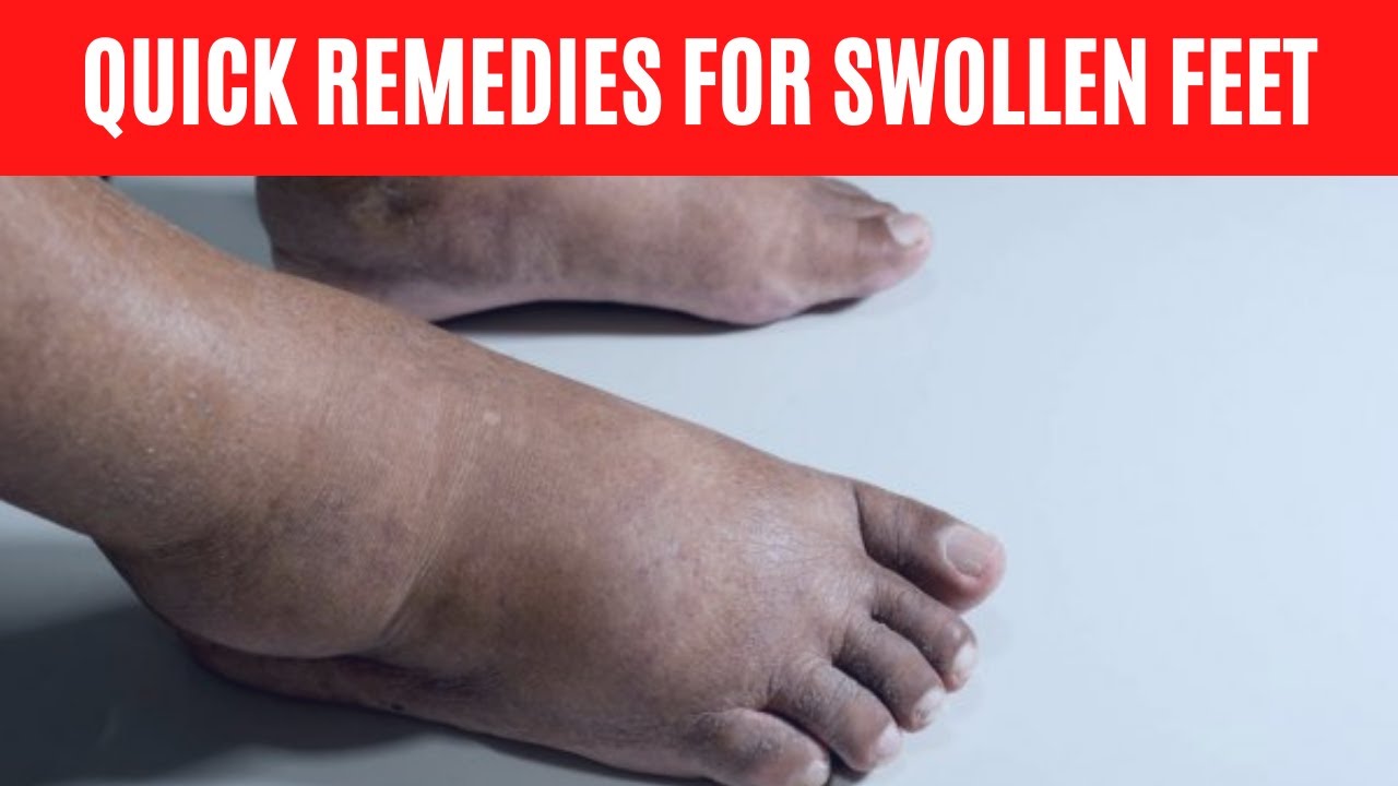 Home Remedies for Swollen Feet Edema Remedy YouTube