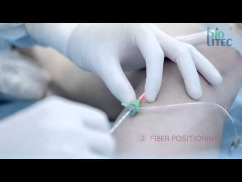 biolitec® medical laser: ELVeS Radial 2ring™ - Laser Therapy today