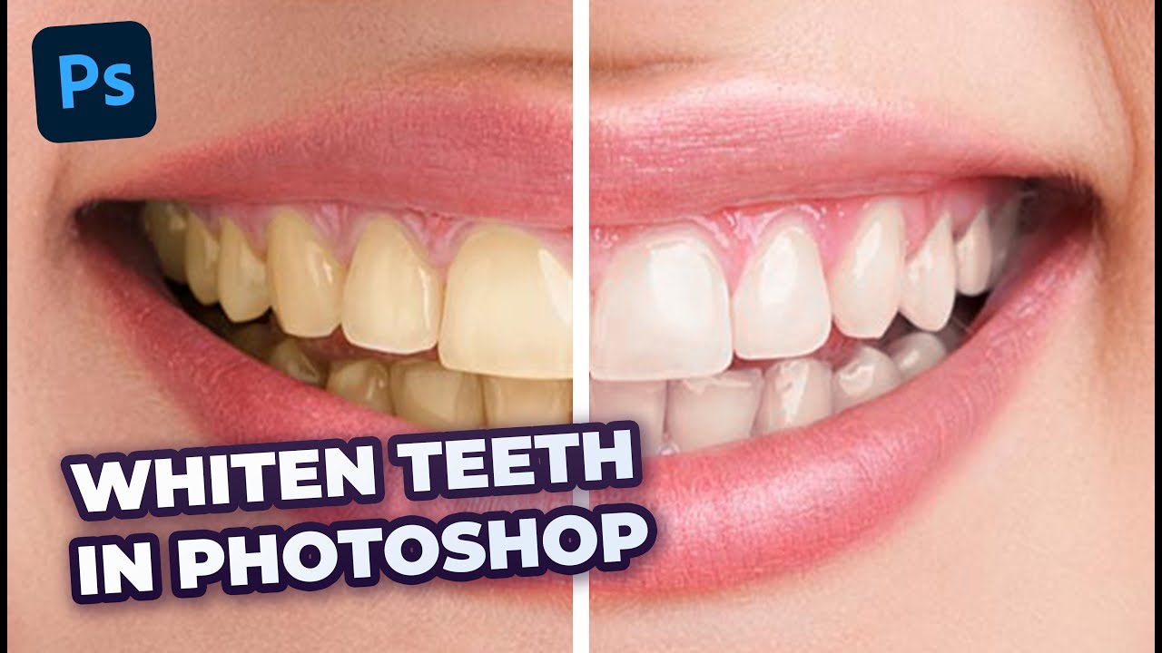 The BEST Way to Whiten Teeth in YouTube