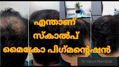 HOW TO INCREASE HAIR DENSITY USING SCALP MICRO PIGMENTATION?