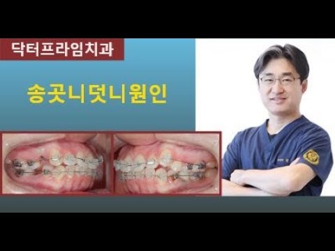 [치아교정] 송곳니덧니원인