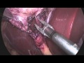 The mount sinai surgical film atlas laparoscopic cholecystectomy