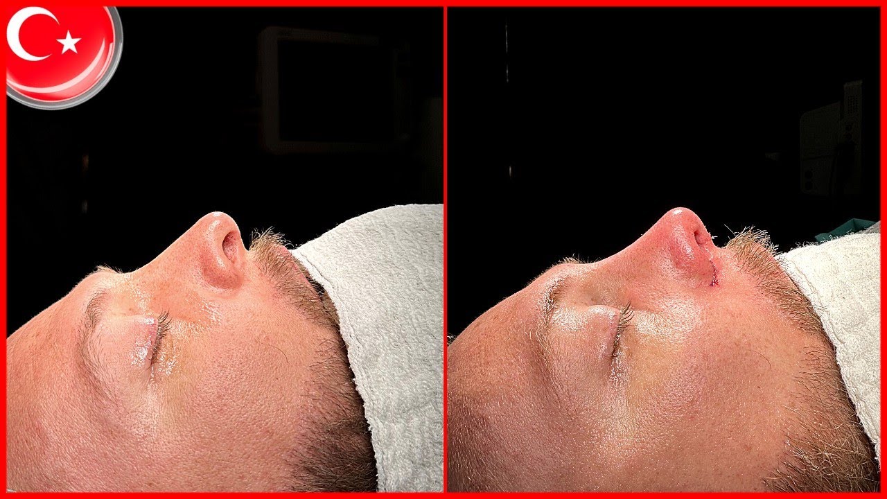 J'ai fait une RHINOPLASTIE en TURQUIE