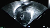 62 - TGA, VSD, narrow aortic arch - YouTube