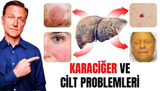 Sağlıklı Cilt İçin Karaciğerinizi Güçlendirin | Dr.Berg Türkçe