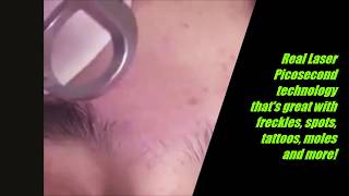 Laser Picosecond Freckle Dark Spot Mole Tattoo Removal Pen