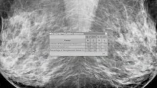 Hologic Worldwide Quantra Volumetric Breast Density Assessment