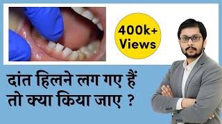 Tooth Mobility Treatment | दांत हिलने के लक्षण, कारण, इलाज | Loose Tooth | Dr. Ankit Khasgiwala screenshot 5