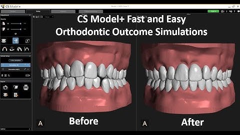 CS Model+ -  Real Time Segmentation and Outcome Simulations