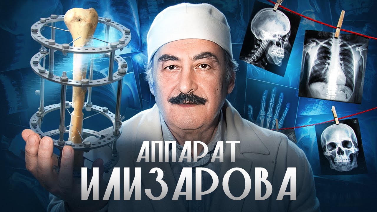 НЕНОВОСТИ: АППАРАТ ИЛИЗАРОВА – как гений из Кургана изменил мировую травматологию