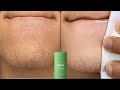 Green Mask Shocking Result || Green mask stick Remove || Acne | pimples|Pigmentation | open porse