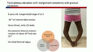 Blount's Disease part 2:  Surgical Technique / Tips & Tricks- J Fernandes