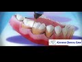 Treatment Of Periodontal Disease Treatment Of Periodontal Disease