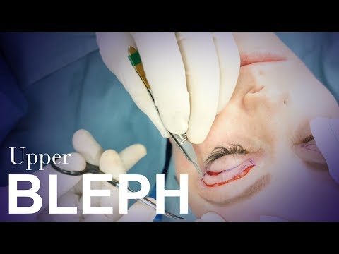 Video: Hvad er øvre blepharoplasty?