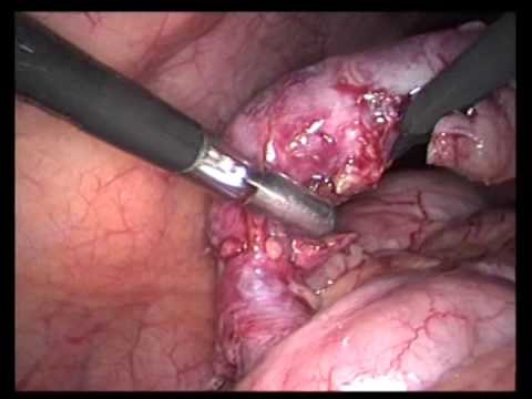 Lap. Appendectomy (unediited-11)-Acute, High Up And Much Dilated Appendix