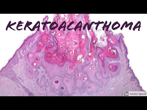 Video: Keratoacanthoma: Definition Och Patient Education