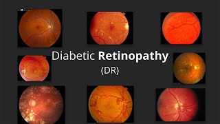 Diabetic Retinopathy (DR) - Pathophysiology, Stages, Screening, Prevention & Management of DR screenshot 4