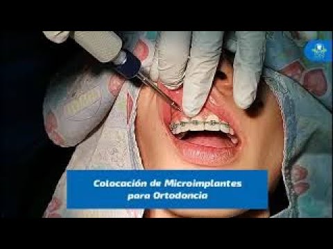 Colocación de Microimplantes para Ortodoncia. - YouTube