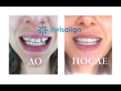 ДО и ПОСЛЕ элайнеры (капы) Инвизилайн (Invisalign) | Результат и отзыв