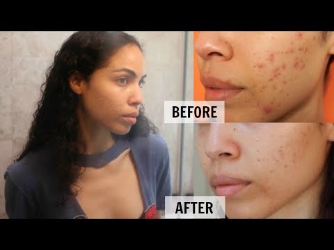 Products I Use to Remove My Acne Scars | Skin Care Routine Results