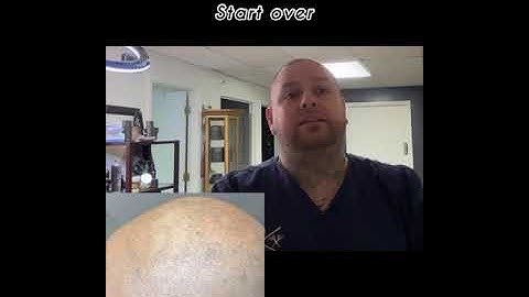 Botched SMP? | What To Do... | Scalp Micropigmentation