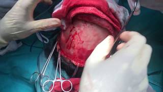 Craniofacial Surgery for Parry Romberg Disease - Dr Richardson