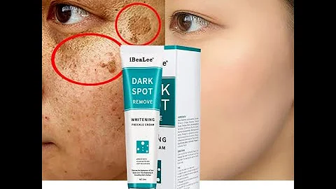 Whitening Freckle Cream Remove Melasma, Dark Spot – iBeaLee™ - DayDayNews