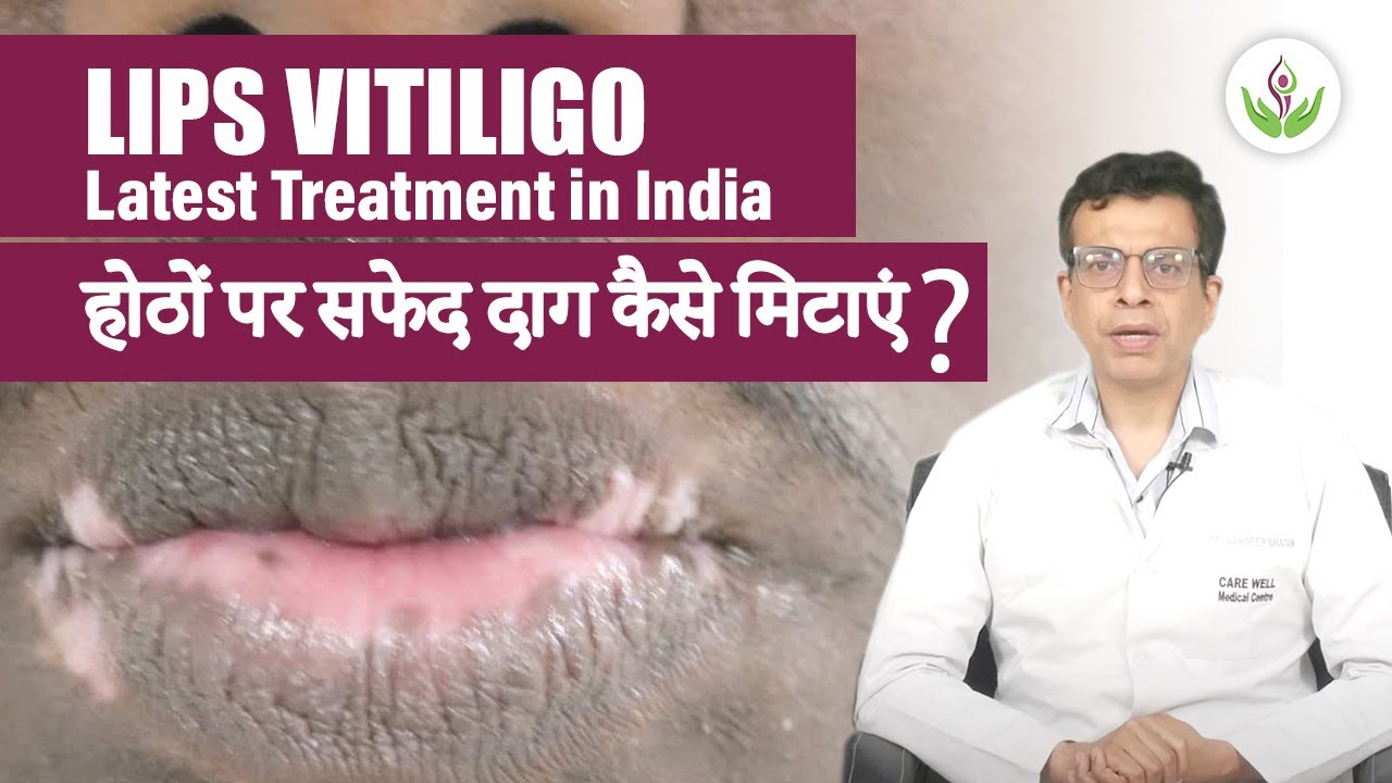 White Spots On Lips Treatment In Hindi