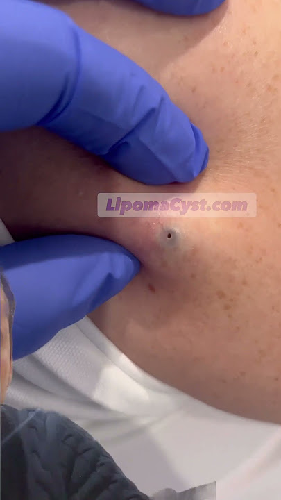 Massive blackhead extraction Dr Khaled Sadek