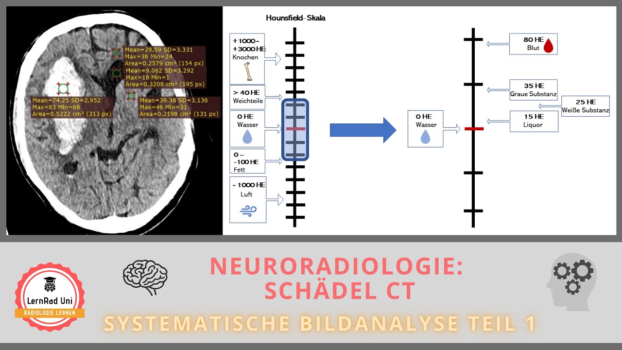 CT Schädel: die richtige Fenster-Technik bei der Bildanalyse