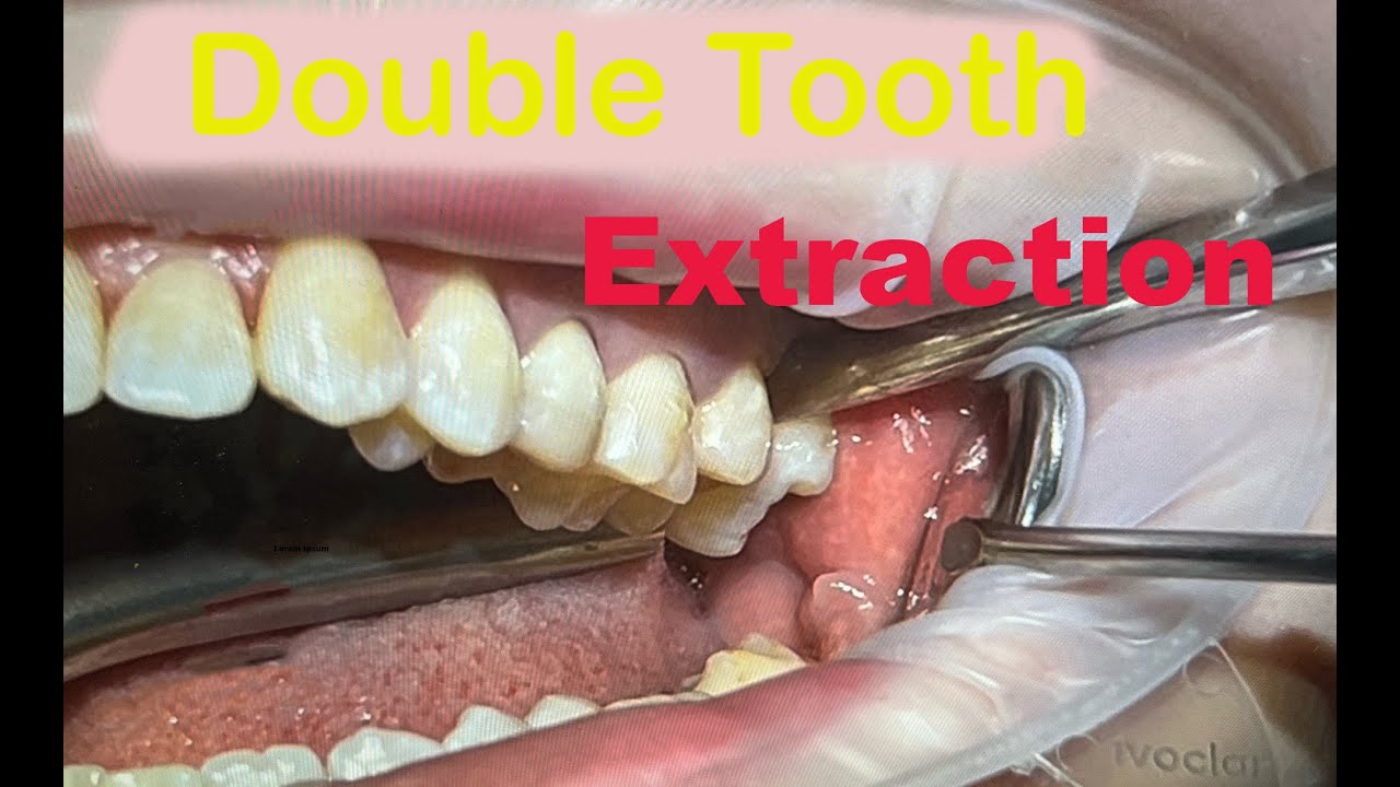 Teeth Extraction Procedure / Live Operation - YouTube