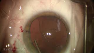 Surgery: Capsular Tension Segment (CTS) Surgical Technique for Dislocated Cataract