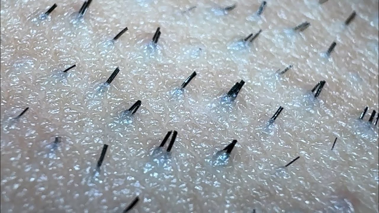 **JUICY** SATISFYING INGROWN HAIR PULL😍😍😍 YouTube