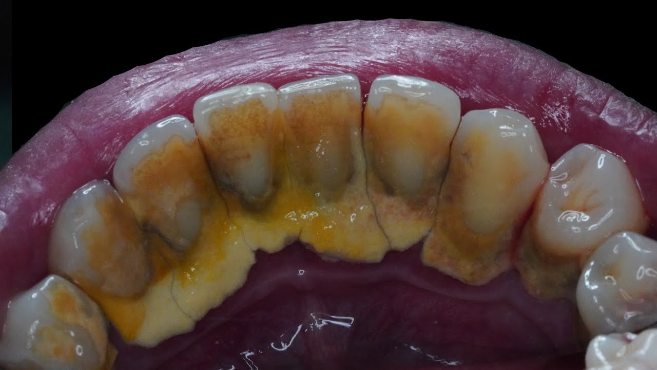 EXTREME CALCULUS REMOVAL (Male, 42yo) Dentist Dokter Gigi Tri Putra