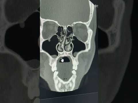 ميلان او انحراف الحاجز الانفي او اعوجاج الوتيرة الانفية