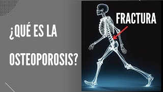 ¿Qué es la osteoporosis?