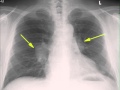 Hilar adenopathy on chest x ray