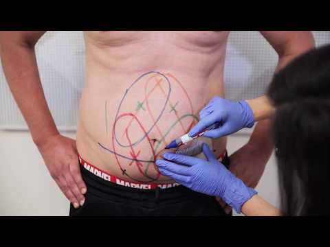 Video: CoolSculpting: Kako Se Pripremiti, Postupak, Trošak, Prije I Poslije