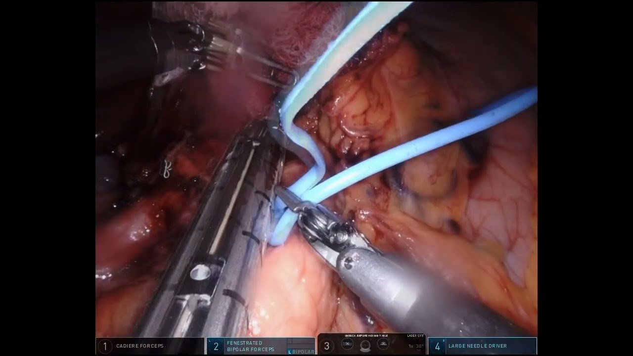 V181 ROBOTIC MULTIPLE RESECTION FOR GASTRIC ADENOCARCINOMA