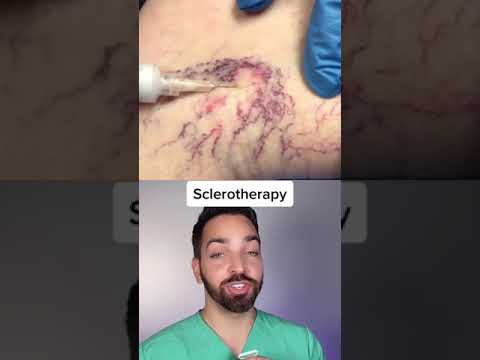 Videó: A spider veins varikózus vénák?