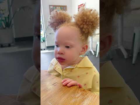 What Type Of Albinism Does Zayana Have Albinismawareness Albinismisbeautiful Albino