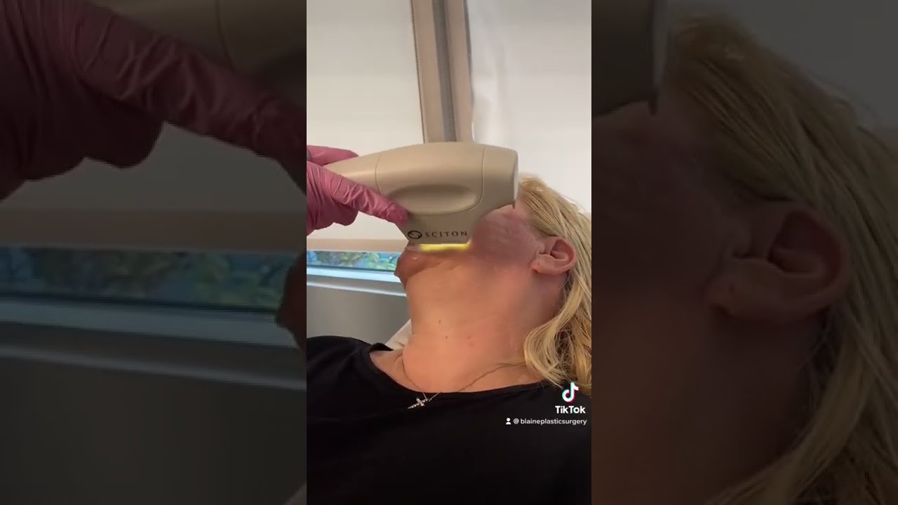 NYC BBL Photofacial | Broadband Light Photofacials Long Island | Blaine Plastic Surgery