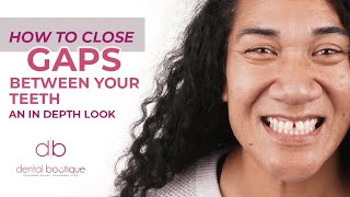How To Close Gaps Between Your Teeth An In Depth Look | Dental Boutique