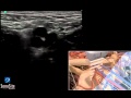3D-пособие: Катетеризация бедренной артерии под контролем ультразвука